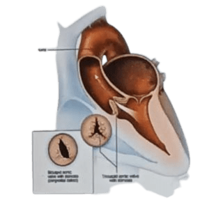 Heart valve replacement doctor Bhopal