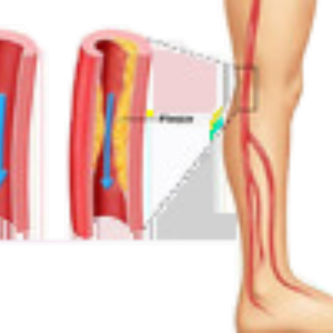 Peripheral Arterial Disease 